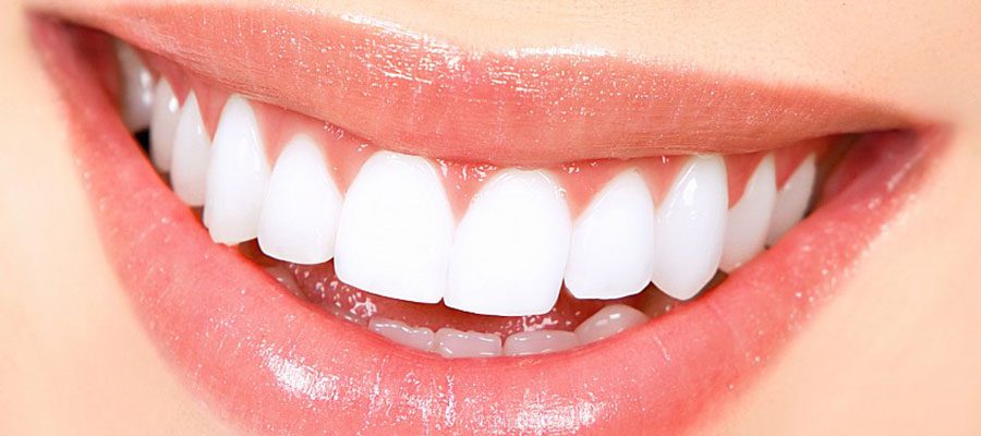 Teeth whitening bleaching 2